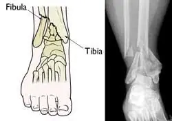 Tibial Fibular Fractures