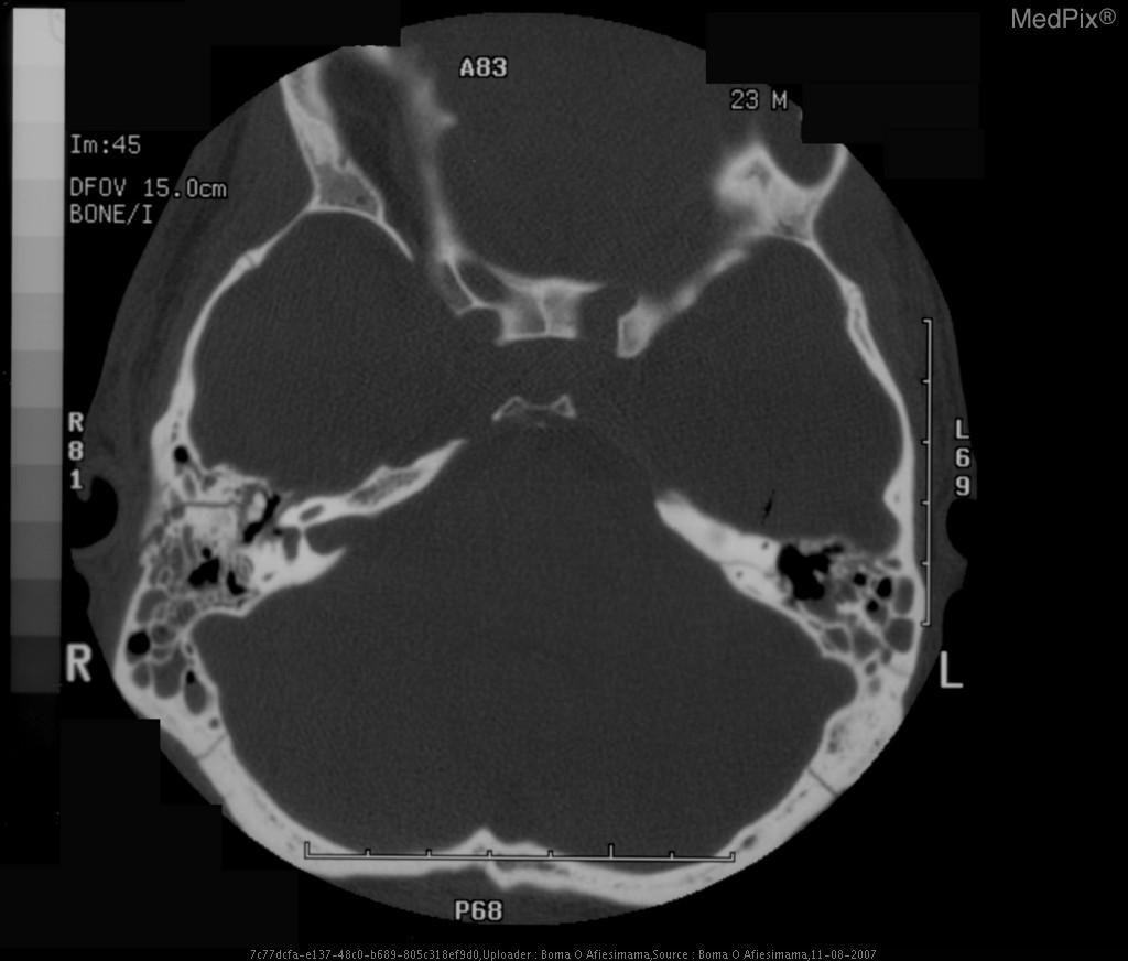 halo sign basilar skull fracture