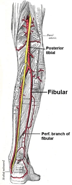 Car Accident Tibia Fractures