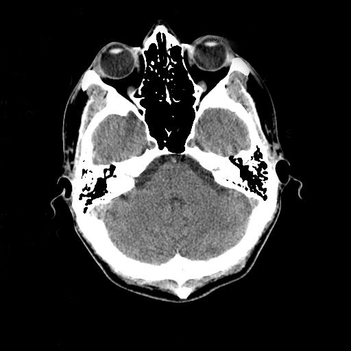 Head_CT_scan