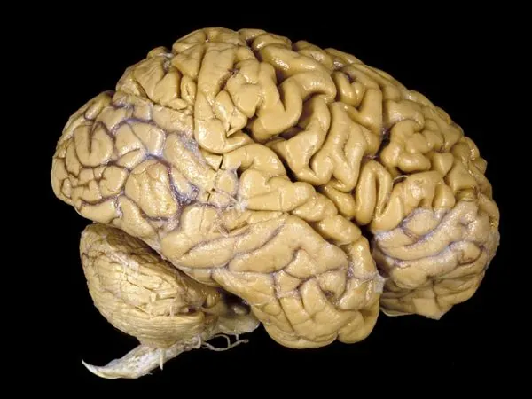 Traumatic Brain Injury Symptoms