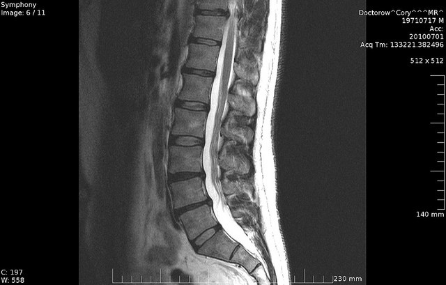 How To Read An MRI Of The Cervical Spine