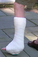 Bone Fracture Injury Lawyers