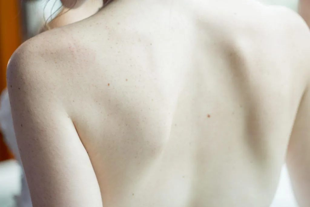 Broken Shoulders from Accidents