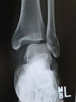 trimalleolar equivalent fracture