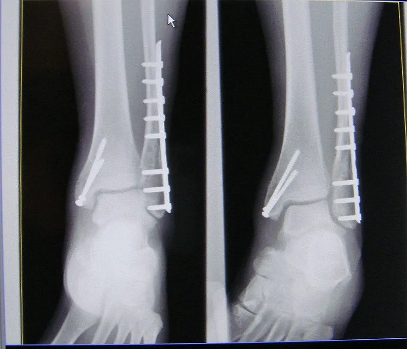 what is a trimalleolar fracture