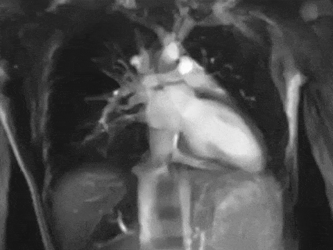cardiac contusion blunt chest trauma