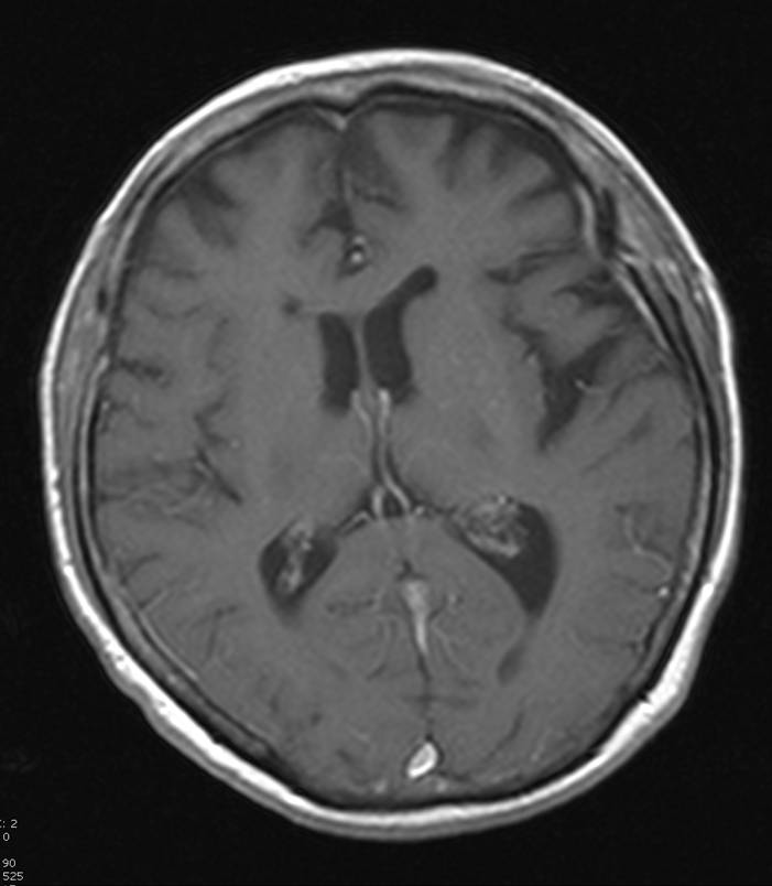 Comparison of Penetrating and Blunt Traumatic Brain Injuries