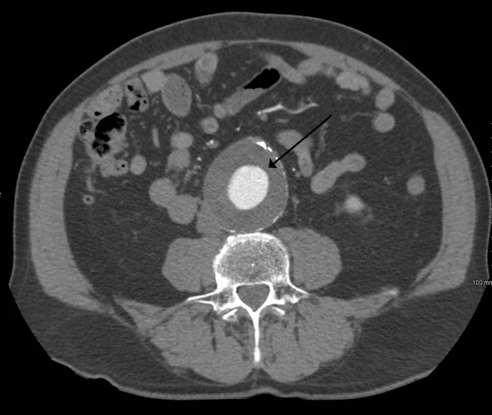 Organ Damage from Sternal Trauma