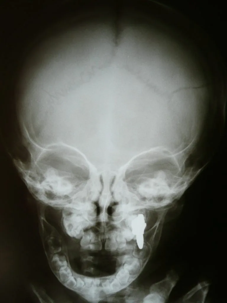 Causes of Facial Fractures