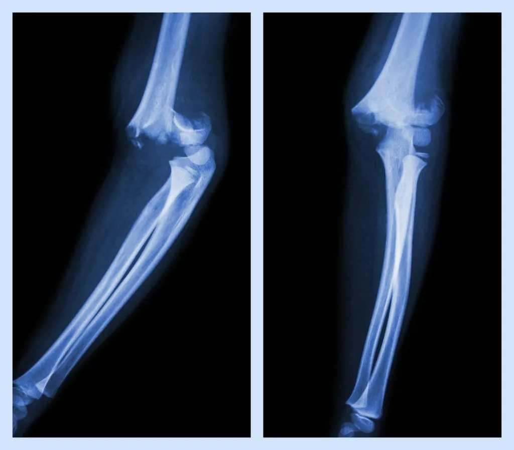 Elbow Fracture Complications