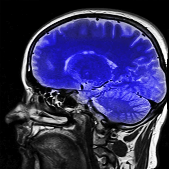 Inflammation Following Brain Injuries
