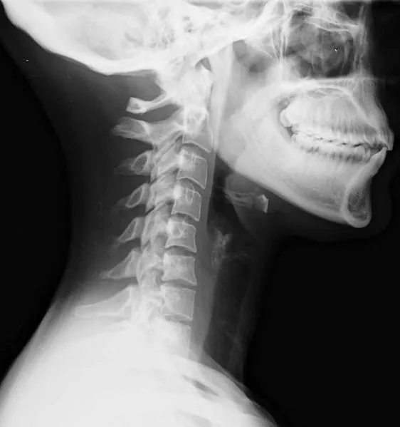 Pedestrian Cervical Spine Injuries in Children