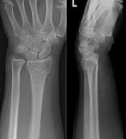 Hand and Wrist Fractures are Common